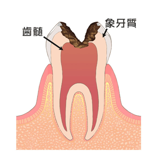 Ｃ３：神経まで達した虫歯